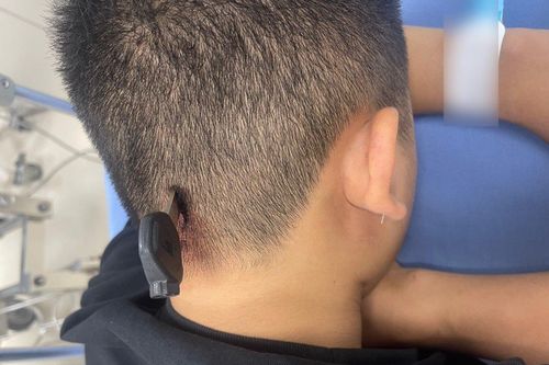 Hy hữu nam thanh niên bị chìa khóa cắm vào đầu