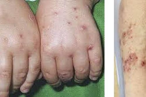 Nên và không nên làm gì khi trẻ hay sẩn ngứa vào mùa hè?