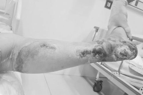 Nữ bệnh nhân phải cắt cụt chân vì biến chứng của đái tháo đường