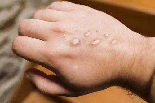 Nguy cơ mắc đậu mùa khỉ ở trẻ em