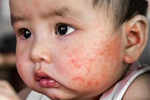 Chuyên gia khuyến cáo bệnh viêm da cơ địa trái mùa