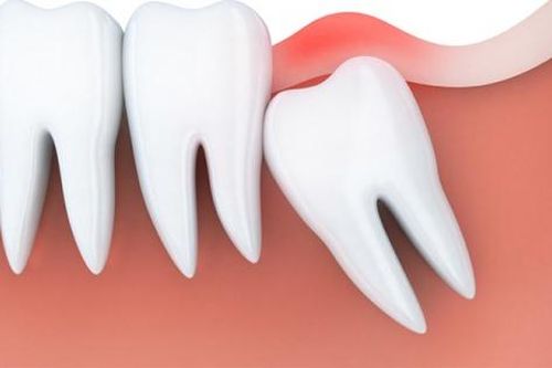 Áp xe vùng mặt do chủ quan với biến chứng mọc răng khôn