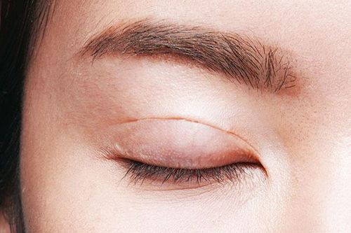 Người phụ nữ bị thủng 4 lỗ trong mắt, vỡ thủy tinh thể vì cắt mí