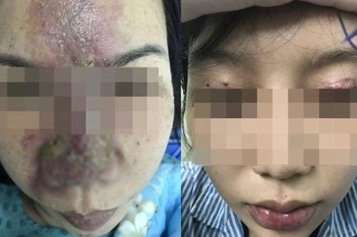 Người phụ nữ bị thủng 4 lỗ ở mắt, nguy cơ mù vì cắt mí