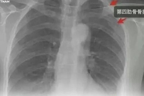 Bị đồng nghiệp nam ôm chặt, cô gái gãy 3 xương sườn ở Trung Quốc