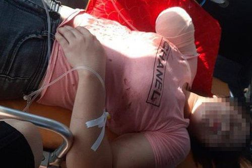 Vụ lật xe chở 21 công nhân: Nữ nạn nhân suy sụp khi cánh tay đứt lìa không thể nối lại