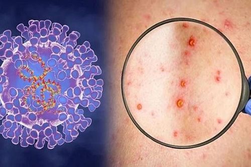 Các địa phương đẩy mạnh giám sát dịch bệnh đậu mùa khỉ tại các cửa khẩu