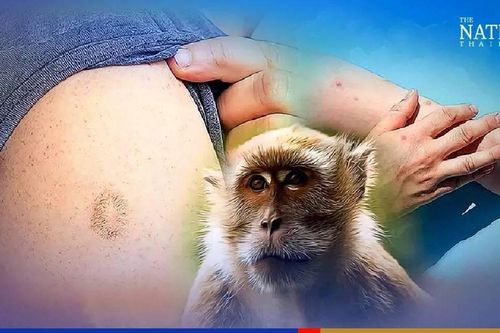 Thái Lan: Vaccine đậu mùa có khả năng bảo vệ khỏi bệnh đậu mùa khỉ