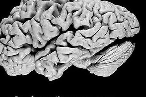 Thuốc mới điều trị bệnh Alzheimer