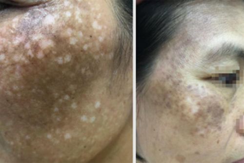 Da mặt loang lổ như pháo hoa vì đắp 'thần dược' trị nám, trắng da