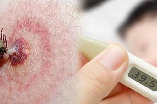 Liên tiếp các ca bệnh nhập viện do sốt mò, cần làm gì để phòng bệnh?