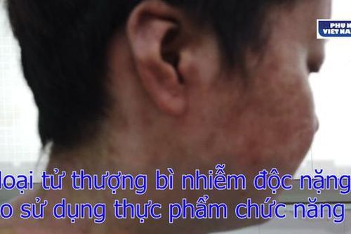 Hoại tử thượng bì nhiễm độc nặng do sử dụng thực phẩm chức năng
