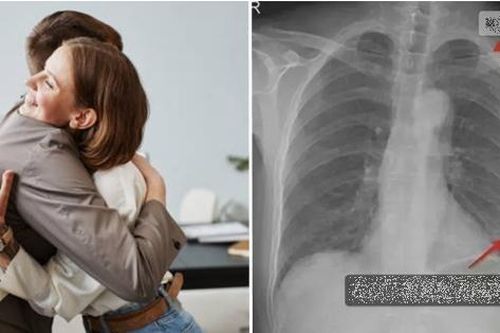 Bị đồng nghiệp ôm chào hỏi mạnh đến mức gãy luôn 3 xương sườn, cô gái Trung Quốc khởi kiện