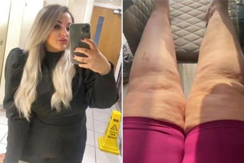 Căn bệnh bí ẩn khiến cô gái tăng cân vù vù dù chỉ ăn 1 bữa mỗi ngày