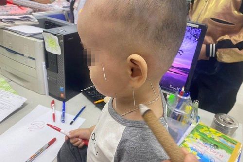 Bé trai 1 tuổi liệt mặt, méo miệng vì nằm quạt sai cách