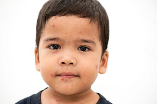 Xuất hiện dịch cúm bí ẩn ở trẻ em tại Ấn Độ
