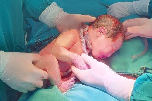 Cứu thành công sản phụ U40 mắc rau tiền đạo trung tâm, băng huyết nguy kịch