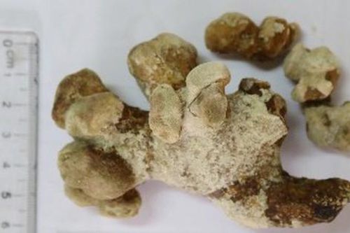 Sốc với viên sỏi san hô 'khủng' trong người đàn ông