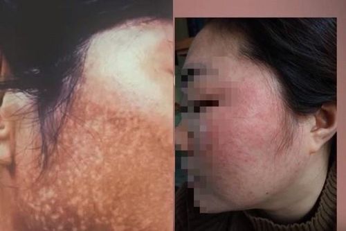 Từ vụ thu hồi lô kem trị nám chứa thủy ngân vượt mức cho phép: Cách nhận diện mỹ phẩm đang dùng có chứa thủy ngân hay không