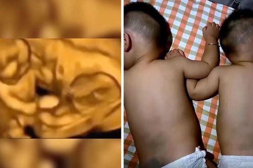 Clip cặp song sinh đấm nhau bầm tím trong bụng mẹ chỉ là trò đùa