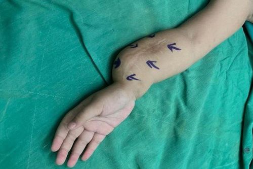 Bé gái 5 tuổi mắc bệnh khớp giả bẩm sinh 2 xương cẳng tay cực hiếm gặp