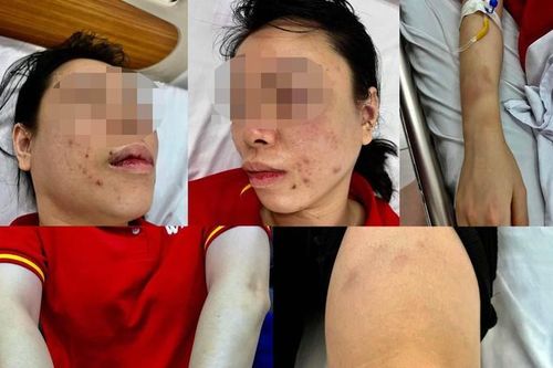 Người phụ nữ tố bị chồng cũ 'bắt cóc' tra tấn dã man: Nhốt trong ô tô, đánh từ Hà Nội lên Hòa Bình