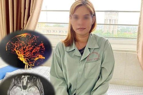 Bị huyết khối tĩnh mạch não do lạm dụng thuốc tránh thai đường uống