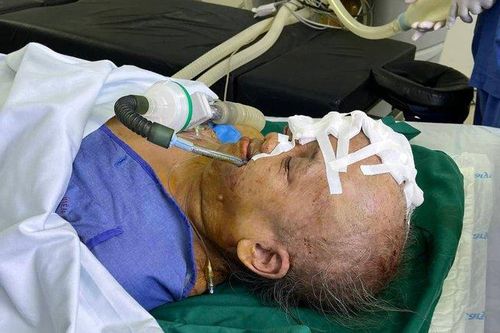 Giải phóng khối u 'quái' trên mặt cụ bà 73 tuổi