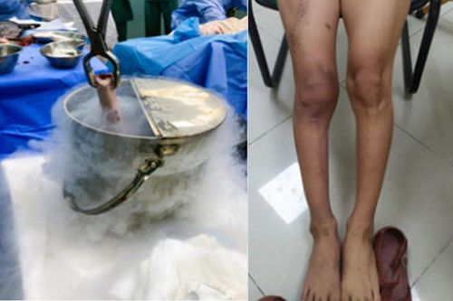 Ngâm xương, bảo tồn đôi chân cho chàng trai mắc ung thư