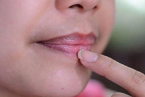 Môi có dấu hiệu này, cẩn thận kẻo mắc bệnh tim mà không biết