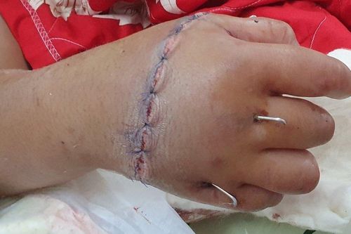 Thâu đêm nối thành công bàn tay phải bị đứt lìa của bé trai 12 tuổi