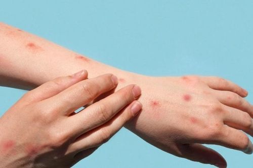 Ca đậu mùa khỉ của Việt Nam được phát hiện sau khi về từ Dubai