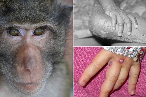 Việt Nam đã có ca mắc đậu mùa khỉ, cần làm gì để phòng chống bệnh?