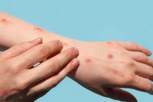 Phát hiện ca bệnh đậu mùa khỉ đầu tiên tại TP. Hồ Chí Minh