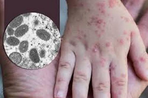Việt Nam phát hiện ca bệnh đậu mùa khỉ đầu tiên tại TP Hồ Chí Minh