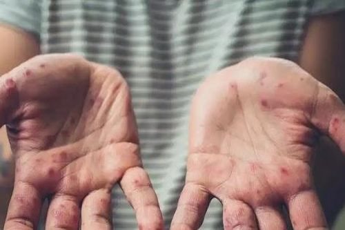 TP.HCM ghi nhận ca bệnh đậu mùa khỉ đầu tiên