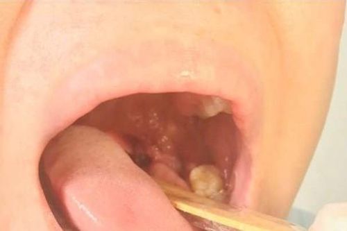 Ca đậu mùa khỉ đầu tiên tại Việt Nam: Sức khỏe đã hồi phục, PCR dịch tiết một số vị trí đã âm tính