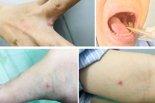 Sức khỏe bệnh nhân mắc bệnh đậu mùa khỉ đầu tiên ở Việt Nam giờ ra sao?