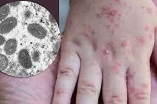 Đậu mùa khỉ có dễ lây không?