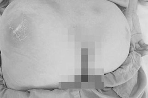 Tự tiêm thuốc bổ vào vùng mông, nữ bệnh nhân bị áp xe phải nhập viện