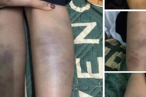 Đà Nẵng: Thực hư vụ học sinh bị đánh bầm tím