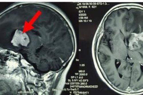 Phát hiện u não ác tính hiếm gặp sau cơn đau đầu dai dẳng
