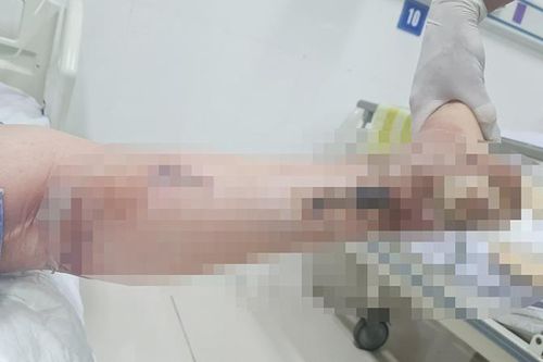 Cảnh báo biến chứng bàn chân do đái tháo đường