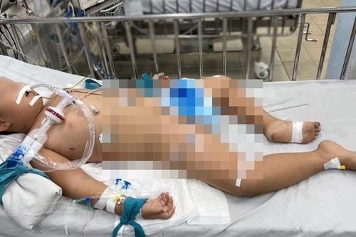 Bé 7 tuổi bị viêm não hoại tử hiếm gặp