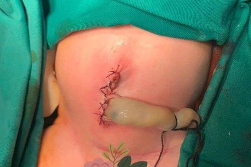Đâu là nguyên nhân bé sơ sinh lộ toàn bộ ruột ra ngoài thành bụng?