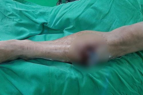 Cấp cứu ca chấn thương do lưỡi cày găm vào chân