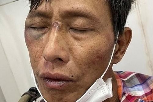Hai công an ở Hải Phòng bị kẻ nhiễm HIV chém