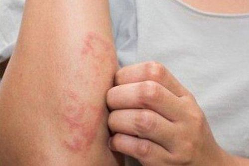 Bác sĩ chỉ cách hạn chế viêm da mùa lạnh