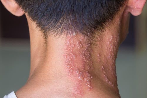 Cảnh báo tự mua thuốc điều trị bệnh Zona thần kinh tại nhà