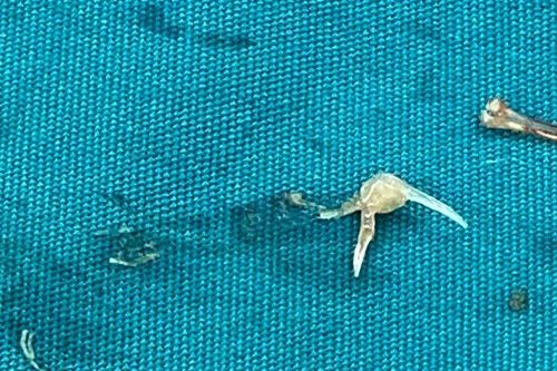 Phẫu thuật lấy xương cá dài 1cm gây thủng hồi tràng bệnh nhân